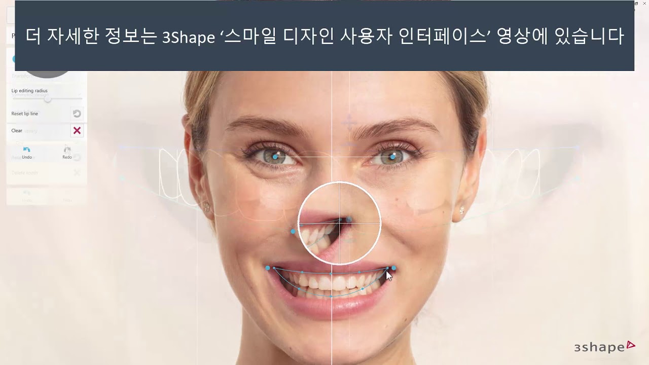 3Shape 스마일 디자인 - 커뮤니케이트 모바일 어플과 스마일 디자인 사용 - 3Shape Smile Design Using ...