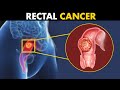 What happens in rectal cancer  symptoms causes and treatment