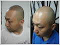 Jason's Scalp Micropigmentation (SMP) treatment experience in Hong Kong Chi.