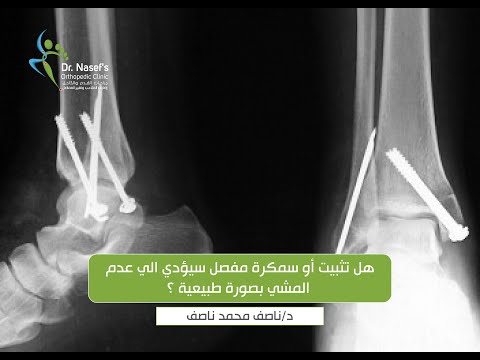 هل تثبيت أو سمكرة مفصل سيؤدي الي عدم المشي بصورة طبيعية تثبيت مفصل الكاحل سمكرة مفصل الكاحل