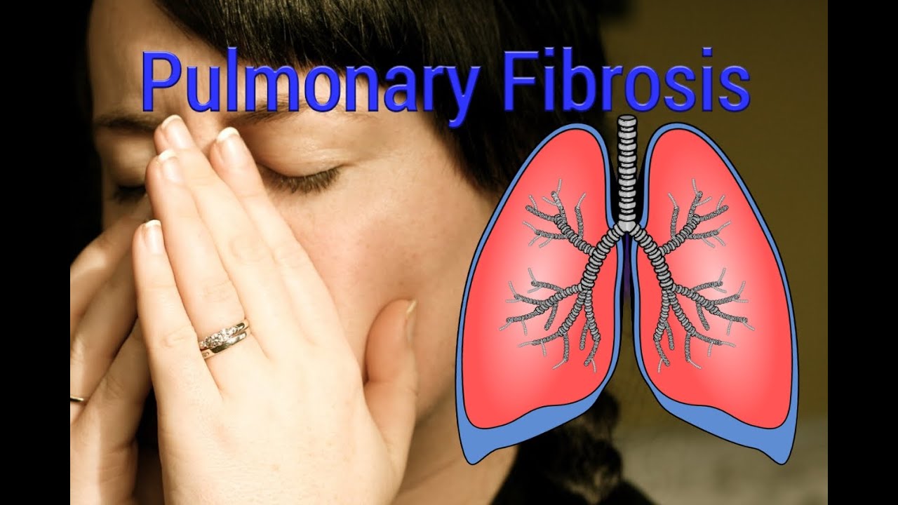 pulmonary fibrosis case presentation ppt