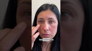 Kristi's Case Part 2: Treatment post dissolving ✨
