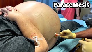 شاهد كيف يتم سحب السوائل من البطن (الأستسقاء) _ Remove abdominal fluid (ascites) | Paracentesis