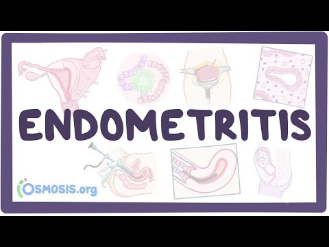 Video: Endometritis - Behandeling, Symptomen, Tekenen