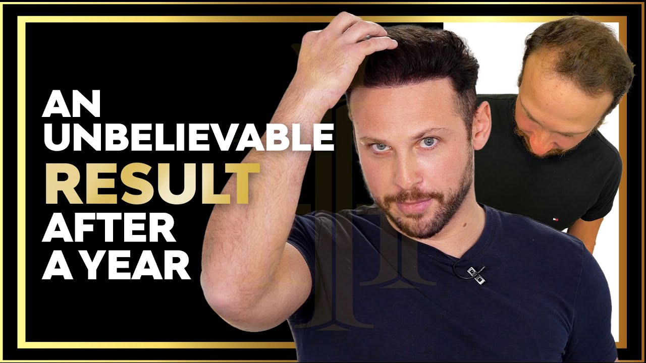 After 1 Year of His Hair Transplant, He Brought His Brother too YouTube