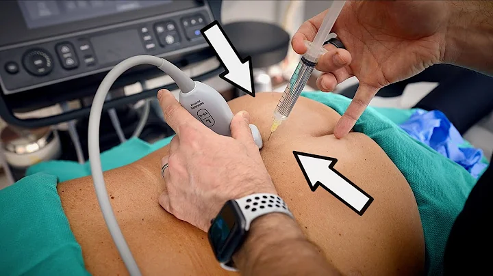 DOCTOR USES ULTRASOUND TO GUIDE HUGE NEEDLES INTO ...
