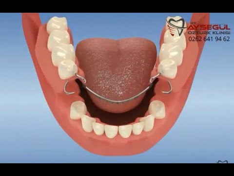 Alt çene metal iskeletli diş protezi uygulaması | takma diş