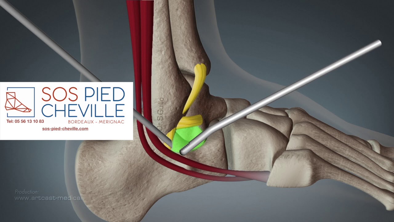 Instabilité de la cheville - SOS Pied Cheville