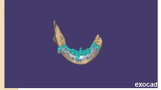 3 in 1 surgical guide- faster  & fixed