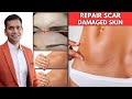 Just 2 Home Remedies Repair Scar &amp; Damaged Skin | Remove Old Scars From Face &amp; Body- Dr.Vivek Joshi
