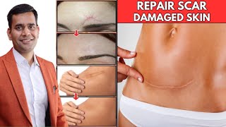 Just 2 Home Remedies Repair Scar & Damaged Skin | Remove Old Scars From Face & Body- Dr.Vivek Joshi