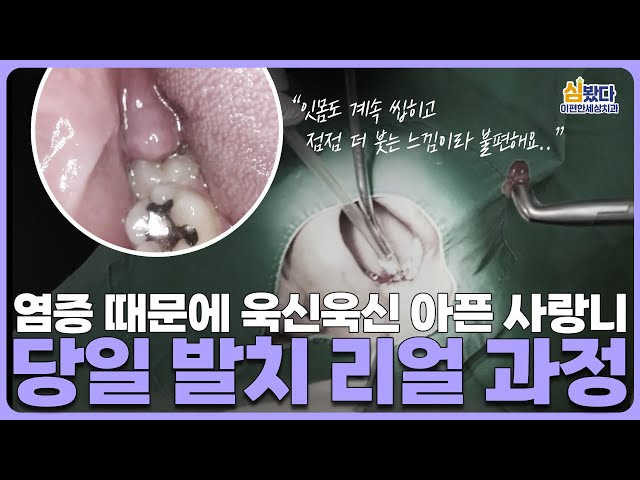 “이 상태로 참을 수가 없었어요.." 염증 사랑니 당일 발치 리얼 과정🦷 ｜ #사랑니발치 #매복사랑니