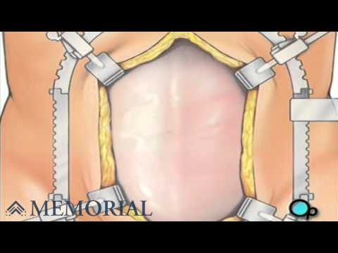 Abdominal Aortic Aneurysm - Open Repair