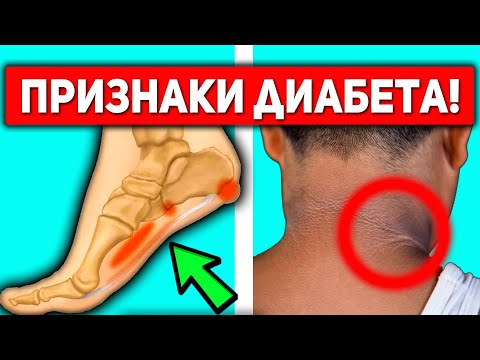 Как Распознать Первые Симптомы Диабета? Не Игнорируйте ЭТИ 15 Признаков Сахарного Диабета...