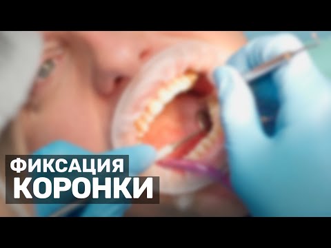 Фиксация металлокерамических коронок. Стоматология Мастер Мед