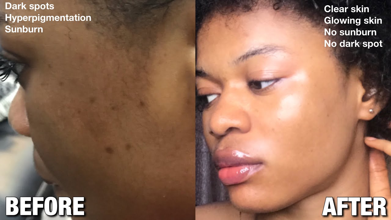 BEST NATURAL INGREDIENTS USE TO GET RID OF DARKSPOT,SUNBURN AND  HYPERPIGMENTATION ON THE SKIN 