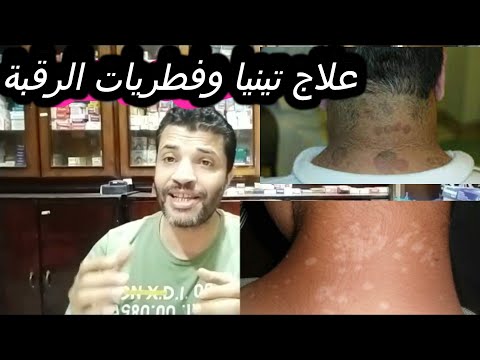 علاج التينيا والفطريات في الرقبة والجسم  
