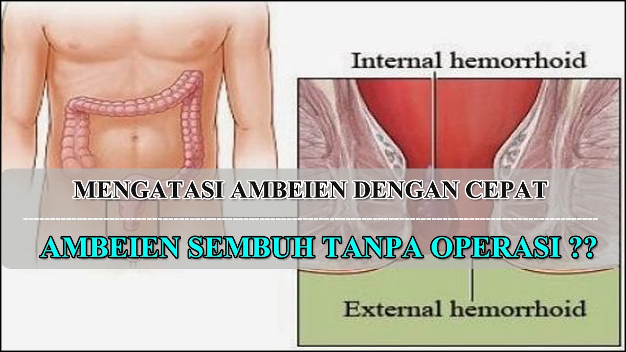 CARA MENGATASI AMBEIEN DENGAN CEPAT | AMBEIEN SEMBUH TANPA OPERASI