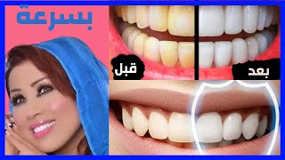تبييض الاسنان - خلطة لتبيض الاسنان الصفراء | تبييض الاسنان مثل سعيدة شرف