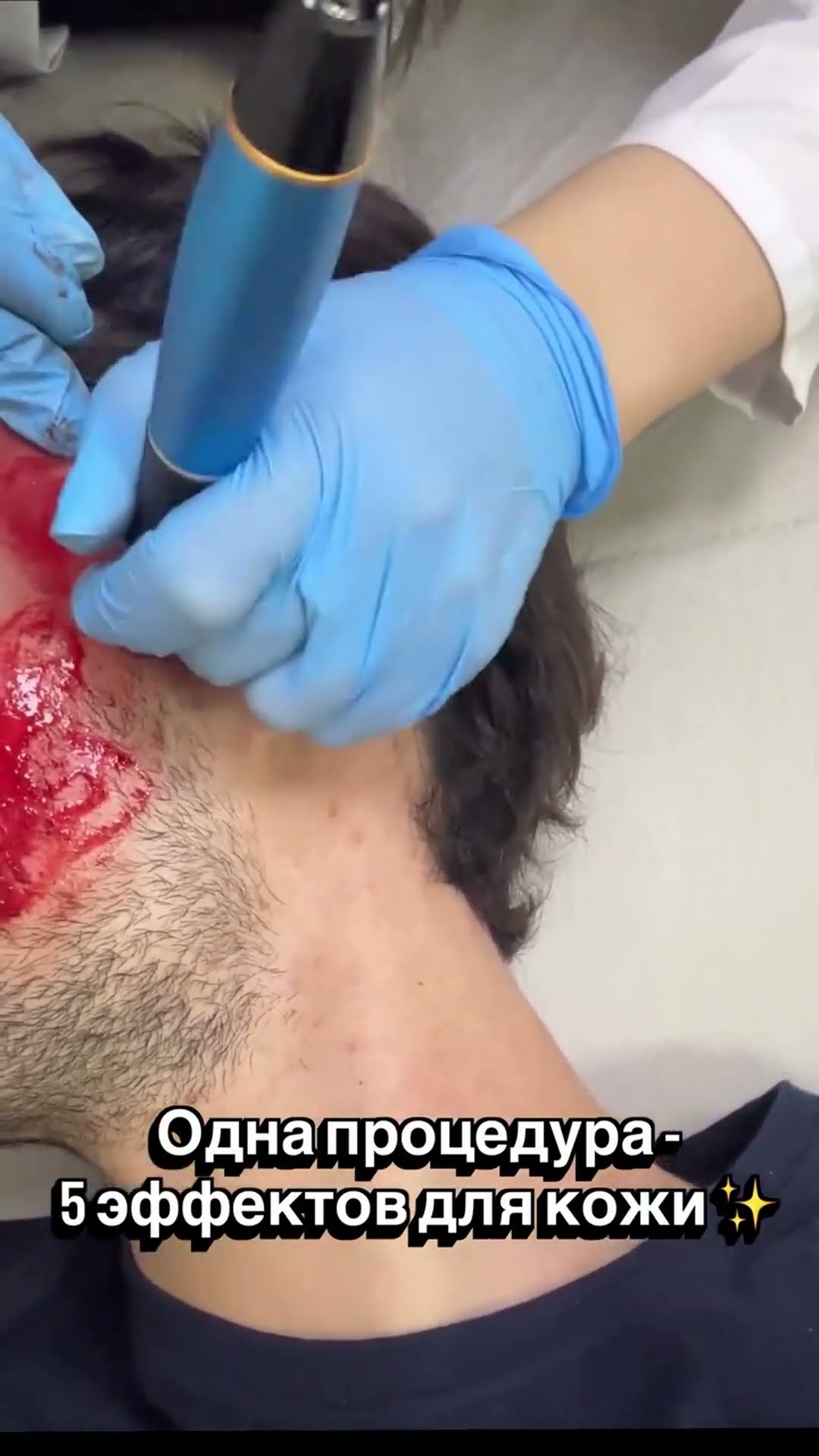Фракционная мезотерапия