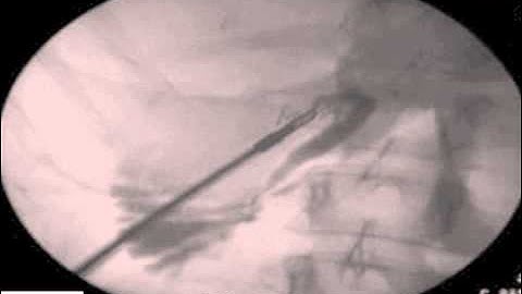 On Table Cholangiogram