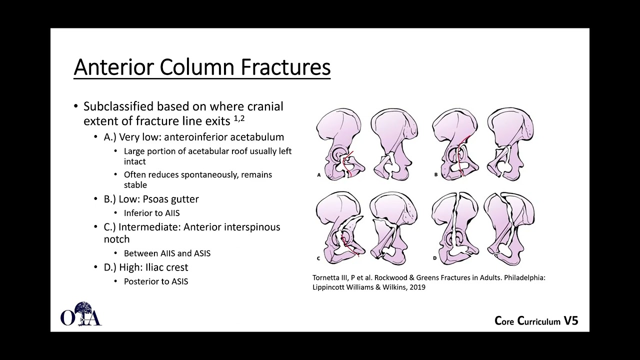 Radiographic evaluation of acetabulum fractures 2 (classification