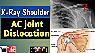 How to read shoulder Joint Dislocation on X-Ray // AC joint Dislocation // Uday XRay