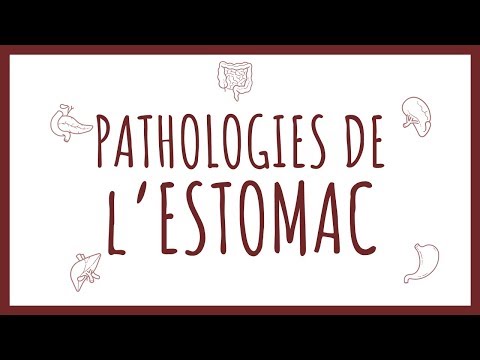 Vidéo: Carcinome De L'estomac De Type Lymphoépithéliome: Rapport De Cas Et Revue De La Littérature