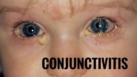 Conjunctivitis #eye #optometry