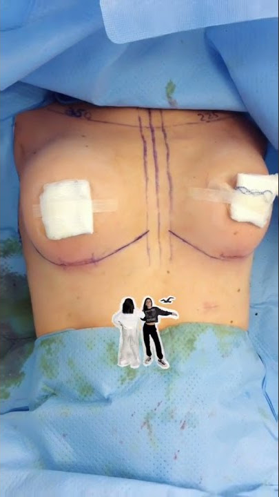 Conservative Breast Augmentation! #shorts