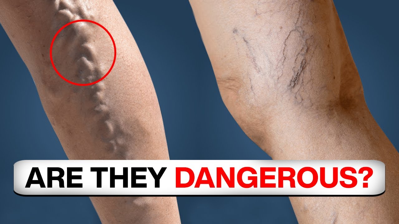 Can VARICOSE VEINS Cause PROBLEMS veincare YouTube Can VARICOSE VEINS Cause PROBLEMS veincare YouTube