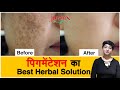 Anti-Pigmentation Regimen | Get Rid Of Pigmentation | Herbal Solution For Pigmentation | Cosmetology