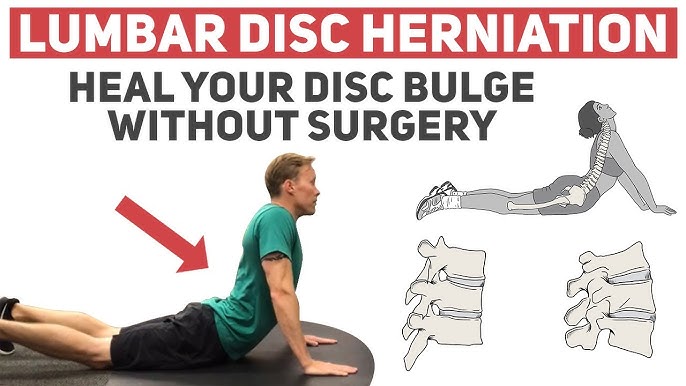 Lower Back Disc Bulges - The 8 Best Exercises to help you with your low back  pain