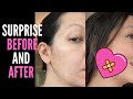 HOW TO COVER UP RED ACNE MARKS AND SCARS WITH MAKEUP (Modified Mikayla Nogueira TikTok Technique!)