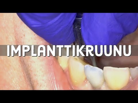 Video: Varhaiset Ja Myöhäiset Hammasimplanttiongelmat