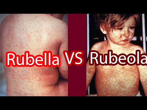 Video: Rubella (Duitse mazelen) herkennen en voorkomen: 9 stappen