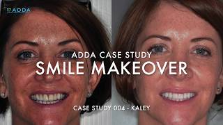 Smile Makeover Case Study 4: Porcelain Veneers & Bite Management Before and After  - Kaley