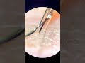 Mosquito Bites My Hand Live Under The Microscope Mosquito Bites My Hand Live Under The Microscope