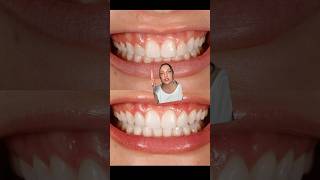 VENEERS BEFORE AND AFTER