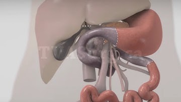 Pancreatoduodenectomía