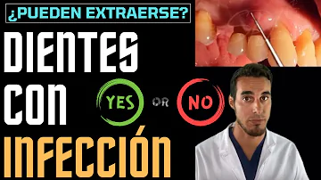 ¿Se puede extraer un diente si está infectado?