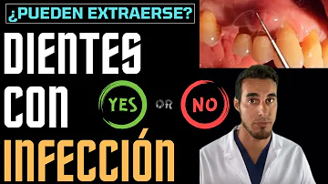 ¿Cuáles son los peligros de extraer un diente con absceso?