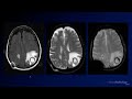 Neuroradiology Board Review - Brain Tumors - Case 3