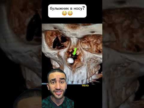 боже мой у него булыжник в носу!