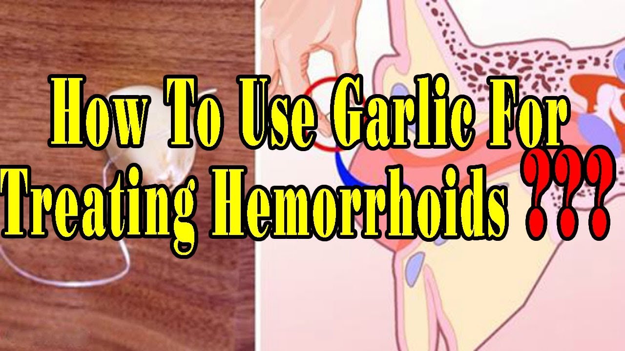 how-to-use-garlic-for-treating-hemorrhoids-activebeat-youtube