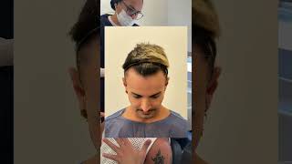 Maquiador da Gloria Groove Conta Como Foi Seu Transplante Capilar Sem Raspar | Depoimento Real