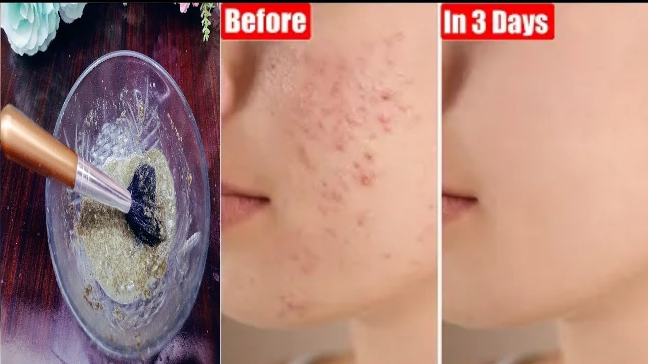 top vitamin deficiency with acne how to get rid of acne acne remedies YouTube