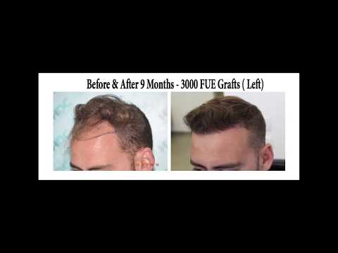 Hair Transplant Results - What to expect - HDC Hair Clinic