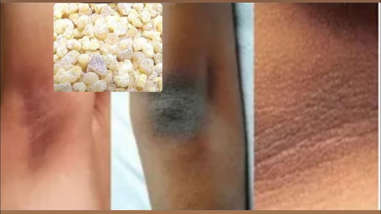 WAA MAXAY FAAIDAD FOOXA ? HALKAN KA DAAWO