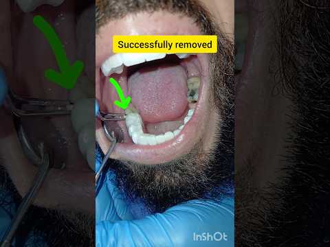 علقت قطعة بين أسناني وش سويت Dentist Satisfying Stitch